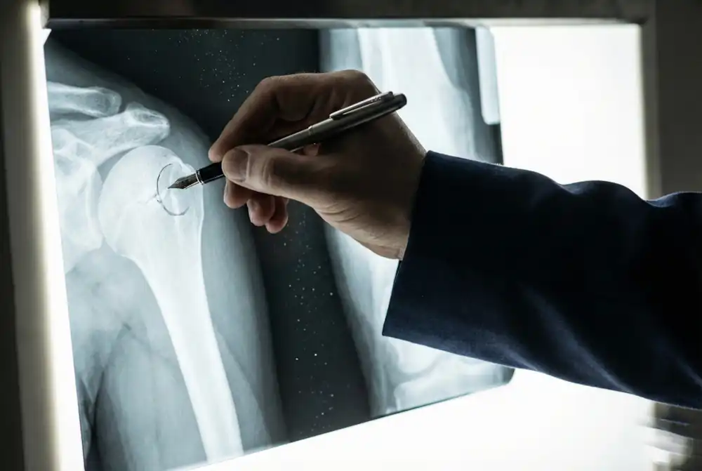 A hand marking a shoulder X-ray with a pen while the imaging record is reviewed for a hospital liability claim.